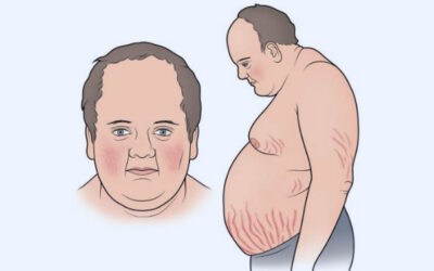 Sindrome de Cushing