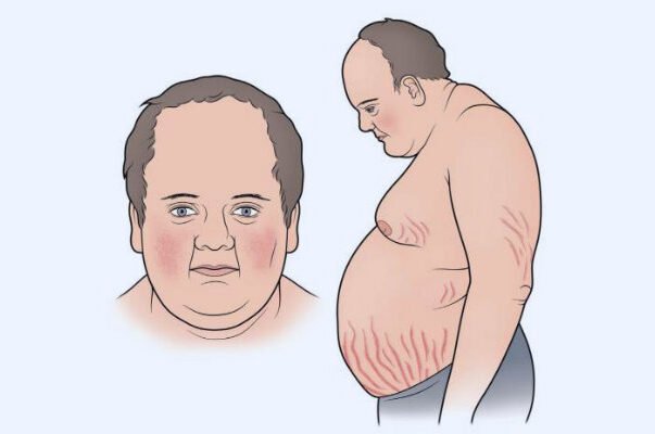 endocrinologia, cushing, sindrome de cushing, dra, doctora, endocrinologa quito, endocrinologia, salud